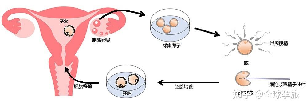 试管婴儿流程三步看懂​-广州好孕试管
